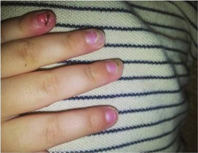 宝宝指甲上有白点是肚子里有蛔虫?长倒刺是缺乏维生素?