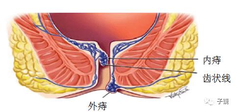2, 痔疮肛垫下移学说:所谓"肛垫"(肛管血管垫)是直肠肛门正常解剖的一