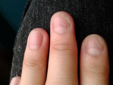 指甲的颜色也会变得越来越浑浊,发黄或者变成灰白色,甚至有些灰指甲