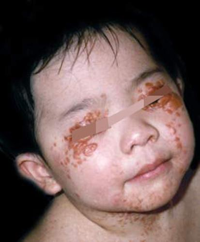 海南2岁多孩子满身咖啡色斑点一查竟是神经纤维瘤孩子身上有咖啡斑