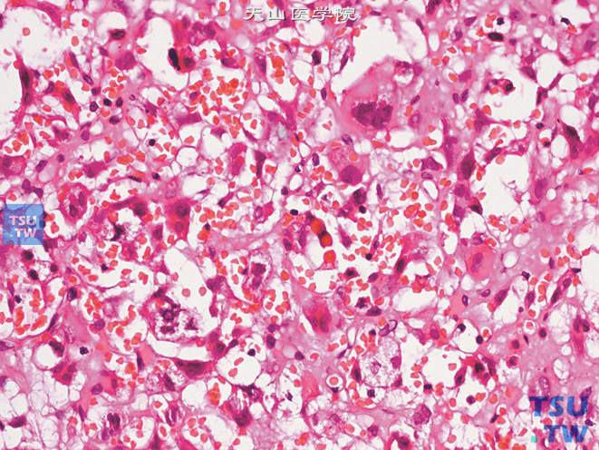 肾上腺髓质肿瘤:嗜铬细胞瘤病理图谱