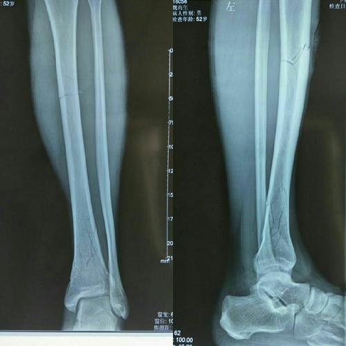 其它 胫骨微创手术 写美篇  患者魏高生,男,52岁,主诉:外伤致左小腿