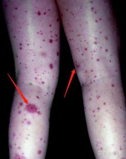 初发的皮疹可融合并演变为典型的瘀斑,瘀点和可触性紫癜皮疹通常成群