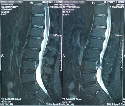腰椎间盘突出椎间孔镜手术3例