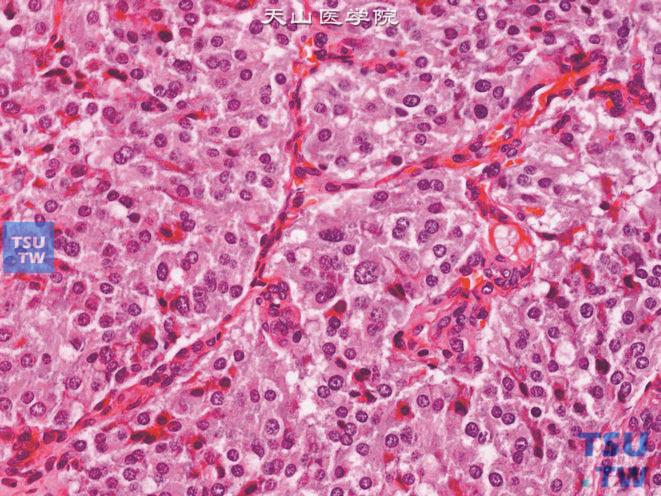 膀胱嗜铬细胞瘤病理图谱