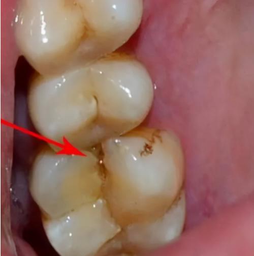 牙根尖周炎早期图片(若出现这6种牙疼不及时治疗) - 赤虎壹号