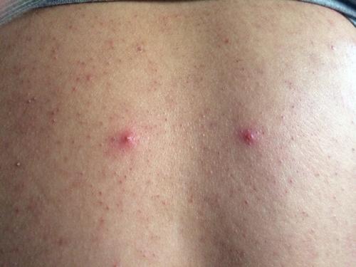 皮肤性病科 性病科 梅毒 → 今天早上发现背部有两个包成对称分布