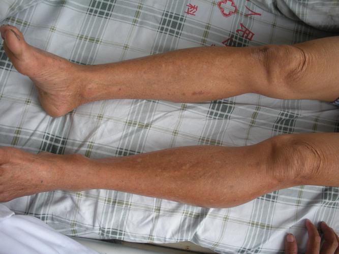 现病史:肿块随年龄增长而增大,初期无疼痛,近5年行走后小腿酸痛