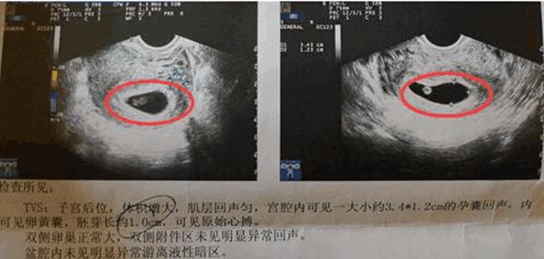 长孕囊和圆孕囊图片孕囊一定是男孩的图片