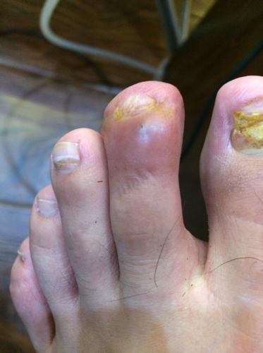 第二个脚趾,一个黑点那里很痛,阵痛,昨晚去温泉泡澡后,穿拖鞋才感觉痛