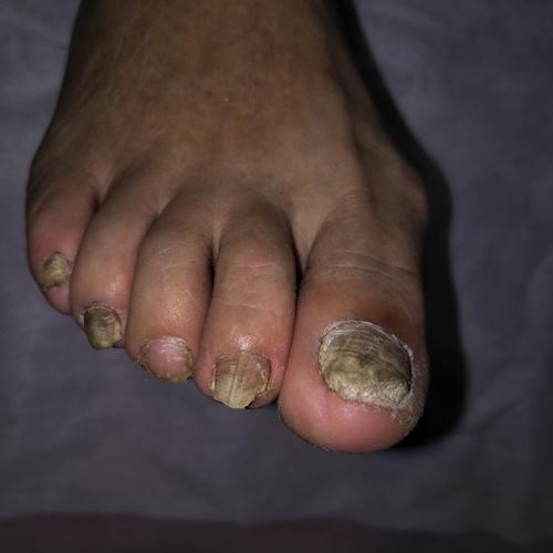 写美篇好东东修脚手足病治疗13261733320 灰指甲是真菌感染引起的