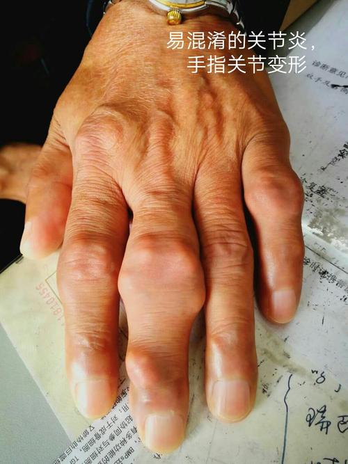 痛风性关节炎致手部皮肤有痛风结石,指关节变形.