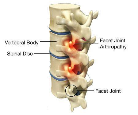 腰椎退变性小关节损伤性关节炎