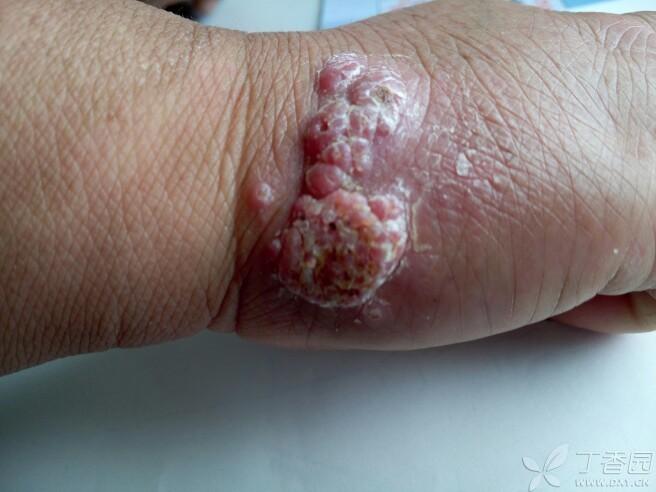 5月前,针刺后出现如图疣状赘生物,两月前出现周围红色囊性丘疹!