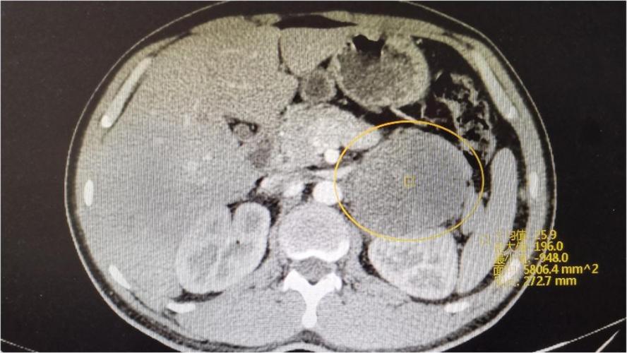 重庆市第五人民医院巨大嗜铬细胞瘤作祟30岁小哥腹部疼痛半月余