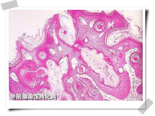keratosis of vulva),别名:老年疣;基底细胞乳头状瘤;外阴脂溢性角化