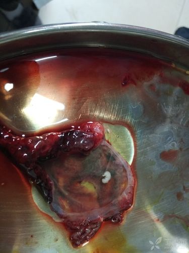 这个是病人孕2 月稽留流产,药流后,清宫术中在宫颈口钳夹出的