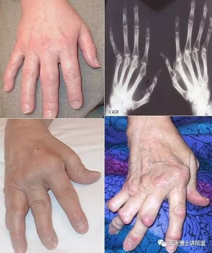 类风湿关节炎如何保护好手关节