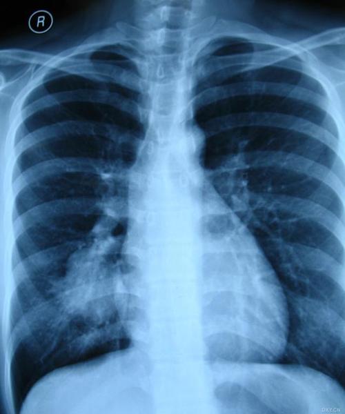 【影像读片】肺部阴影一周入院 公布结果 [病例帖]