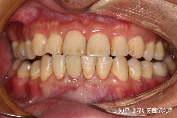 下前牙种植修复一例 - 知乎