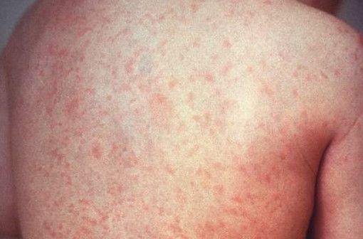 在学龄儿童群体内较为常见的一种病毒疹:风疹