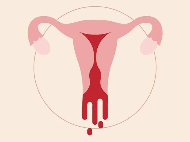 典型的临床表现是子宫出血,腹部的包块和压迫症状,疼痛,白带增多,不孕