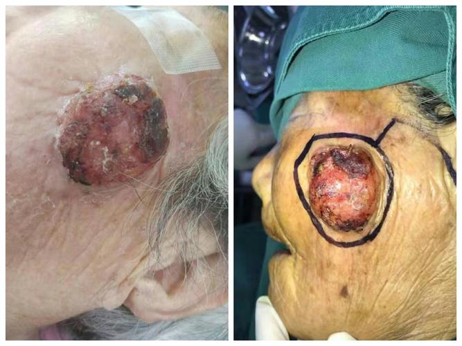 脸上一个"黄豆"般疙瘩,变成"鸡蛋" 般恶性肿瘤!86岁老太住进医院