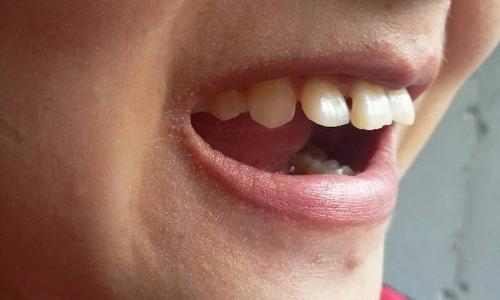 右门牙有个小洞 是龋齿吗 小时候摔过一次把牙给弄得不整齐了 近几天