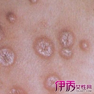 【图】揭秘梅毒早期图片男 了解梅毒三期特征