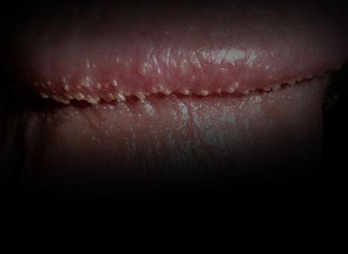 男性珍珠疹和系带旁腺增生症状图片