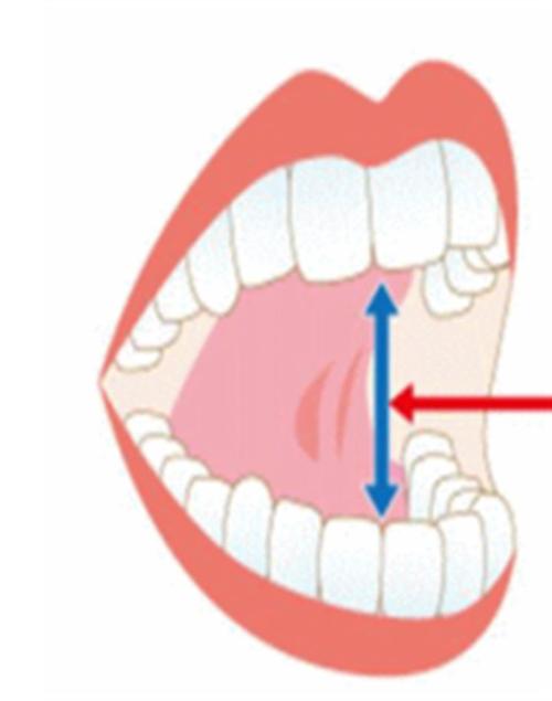 如果舌头上抬,超过嘴张开的1 / 2但未能到达上齿龈,就是轻度.
