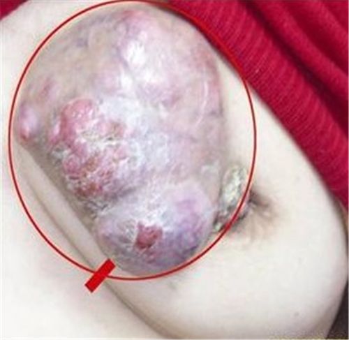 乳腺癌患者乳房的严重溃烂图片