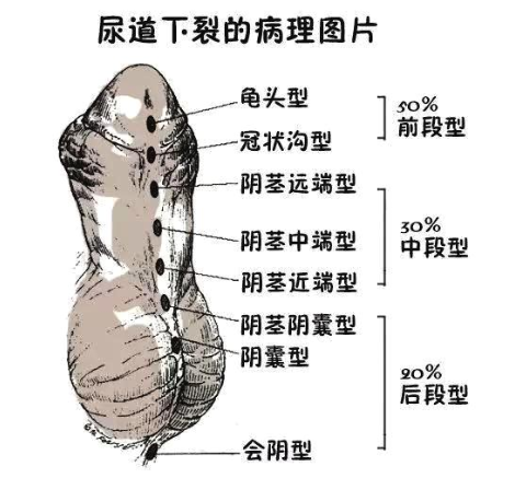 ④会阴型③阴囊型②阴茎型①阴茎头型尿道下裂主要根据尿道开口的位置