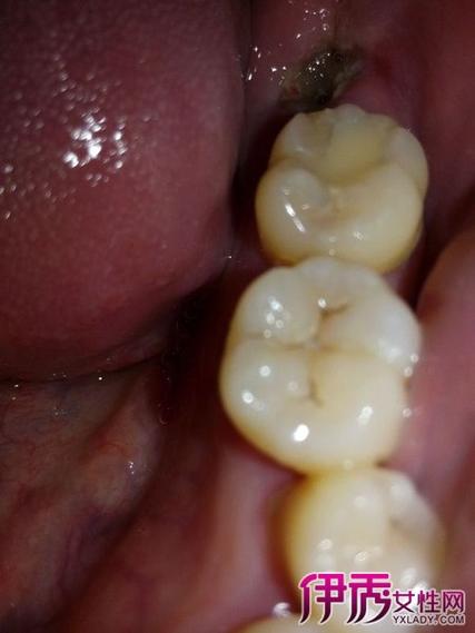 伊秀生活网 健康 / 正文干槽症发生于下颌阻生智齿拔除后,口腔细菌