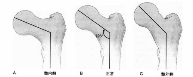 干形成两个重要夹角(radin, 1980):股骨头由2/3球体形成,是髋关节球窝