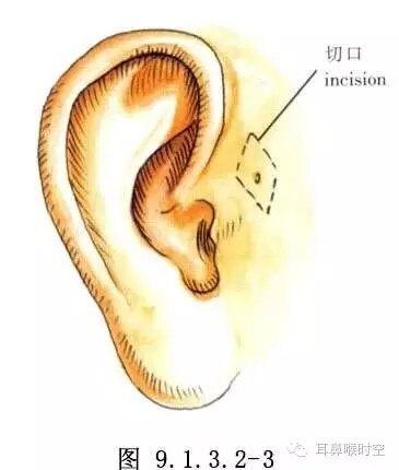 耳前瘘管_先天性耳前瘘管_症状表现_治疗方式 - 好大夫在线
