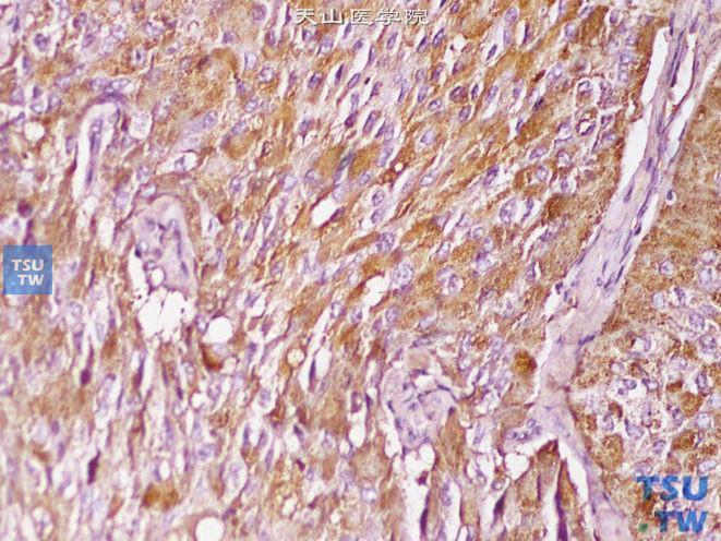 肾上腺髓质肿瘤:嗜铬细胞瘤病理图谱