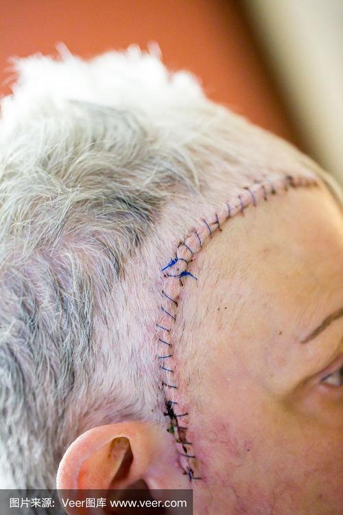 内科:脑部手术后的缝合和切口