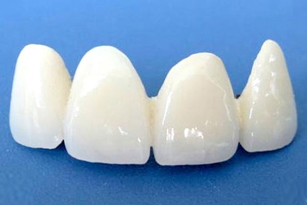 合肥的全瓷牙有哪些优越性能