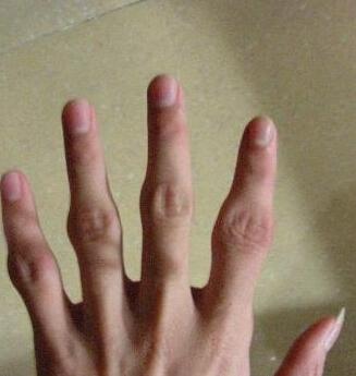 手指关节肿大是怎么回事