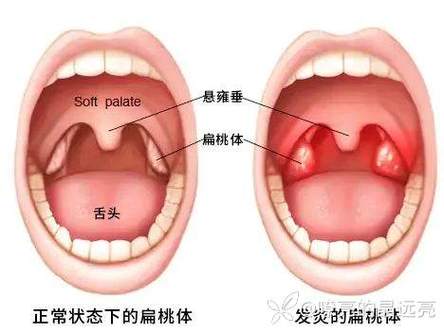 我们通常所说的扁桃体,指的是位于口咽两侧的一双的腭扁桃体.
