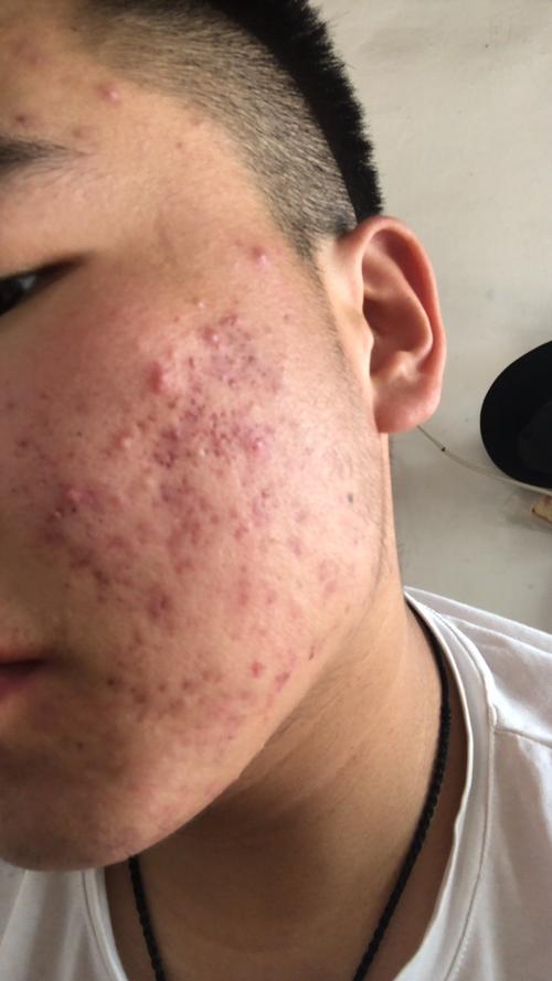 21岁男孩囊肿型痤疮,中药14天后,痘痘明显好转!