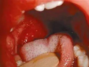 咽喉炎的早期症状|喉癌和链球菌性咽喉炎的区别