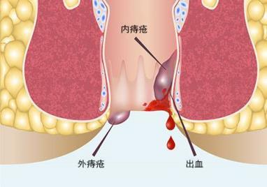 当一个人患有外痔时,肛门边缘的皮肤下会出现红肿的静脉.