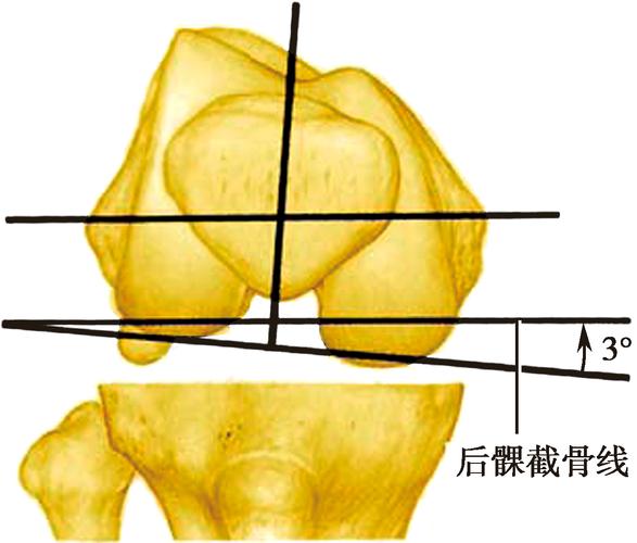 股骨后髁外旋3°截骨,以获得矩形的屈曲间隙正常胫骨平台有3°～5°内