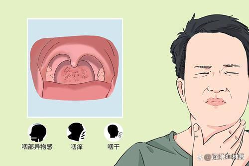 慢性咽炎是指咽部黏膜,黏膜下及淋巴组织的慢性炎症,常为上呼吸道慢性
