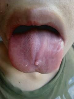 这个是口腔溃疡吗,,,舌头有个小泡,没有其他不适.