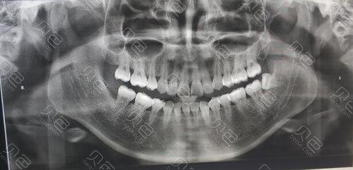 牙齿x光片照片