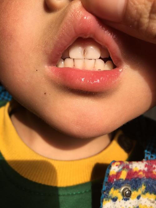 请问下小孩两颗门牙中间有个洞是虫牙吗,需要去看牙科吗