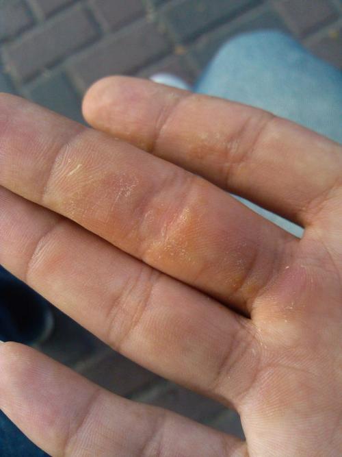 全身 皮肤 瘙痒 部分手指上面有蜕皮的样子,但是又没蜕皮,很干,很痒